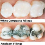 Amalgam vs. Composite Fillings: What’s the Best Option for You
