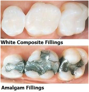 Amalgam vs Composite Dental Fillings