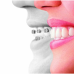 The Real Difference Between Invisalign and Braces