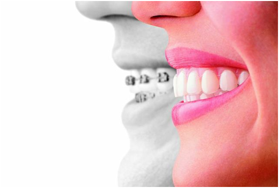 Difference between invisalign and braces