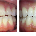 What Are Your Cosmetic Dental Solutions for Chipped Teeth?