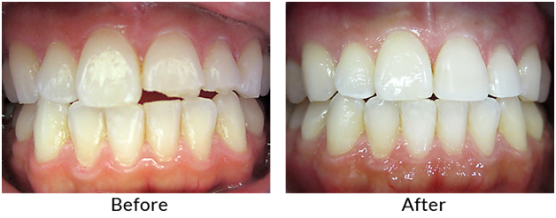 Cosmetic dental solutions for chipped teeth