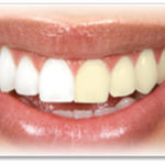 Matching a Teeth Whitening Procedure to Your Needs