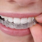 Why Invisalign Is the Right Choice for Adults
