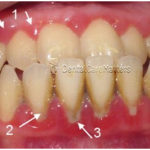 Noticing the Warning Signs of Gum Disease