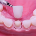 Dental Crowns – What You Need to Know