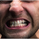 What Is Bruxism and How to Prevent it?