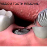 Understanding the Need for Wisdom Teeth Removal