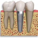 Reasons for Considering Dental Implants