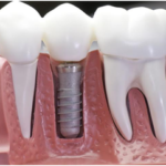 Your Dental Implants Questions Answered