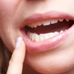 Does My Teen Need a Wisdom Teeth Extraction?