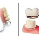 Bridges vs. Partial Dentures – Which is Right for You?