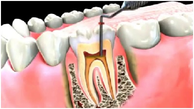 root canals in los angeles