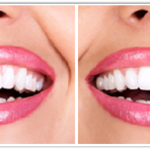 Cosmetic Tooth Bonding: What is It?
