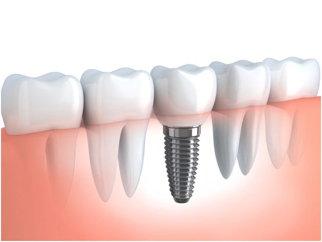 Dental Implants in Los Angeles
