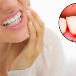 What are the Causes of Bleeding Gums?