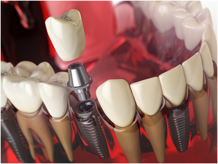 dental replacement with implants