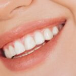 Are You a Good Candidate for Teeth Whitening?