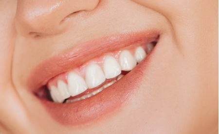 Dentist in Los Angeles – Teeth Whitening
