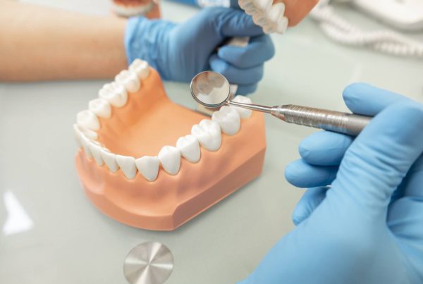 What Are Inlays and Onlays and When Do You Need Them