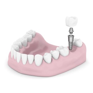 Dental Implants in Los Angeles