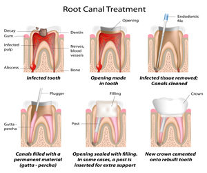 Endodontics Los Angeles