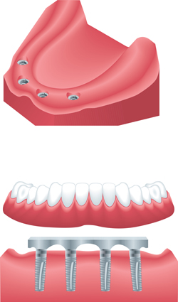 Implant Retained Dentures in Los Angeles