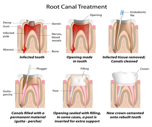 Root Canal Treatment in Los Angeles