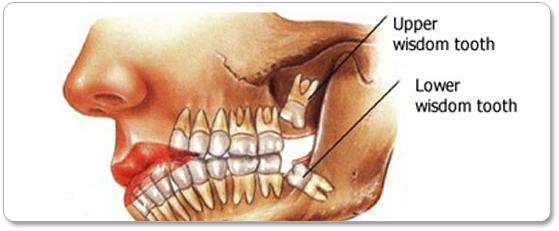 Wisdom Teeth Removal in Los Angeles