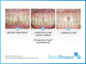 Perio  Protect Trays – Case study 2