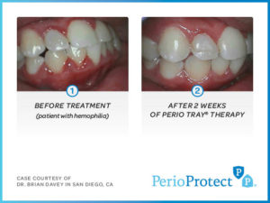 Perio  Protect Trays – Case study 1