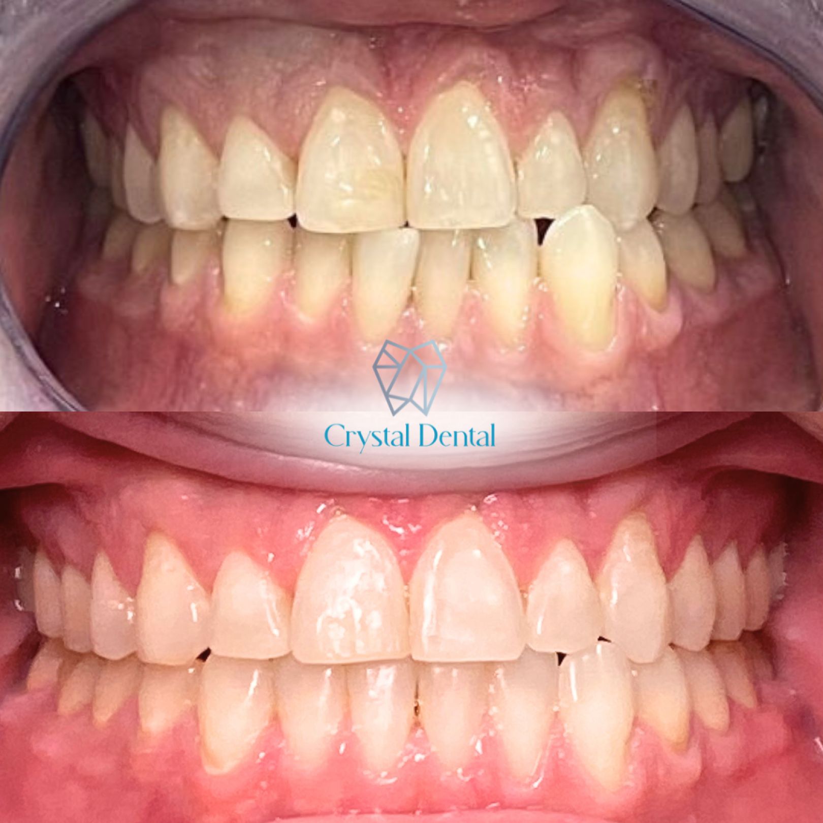 Invisalign Before After - 1