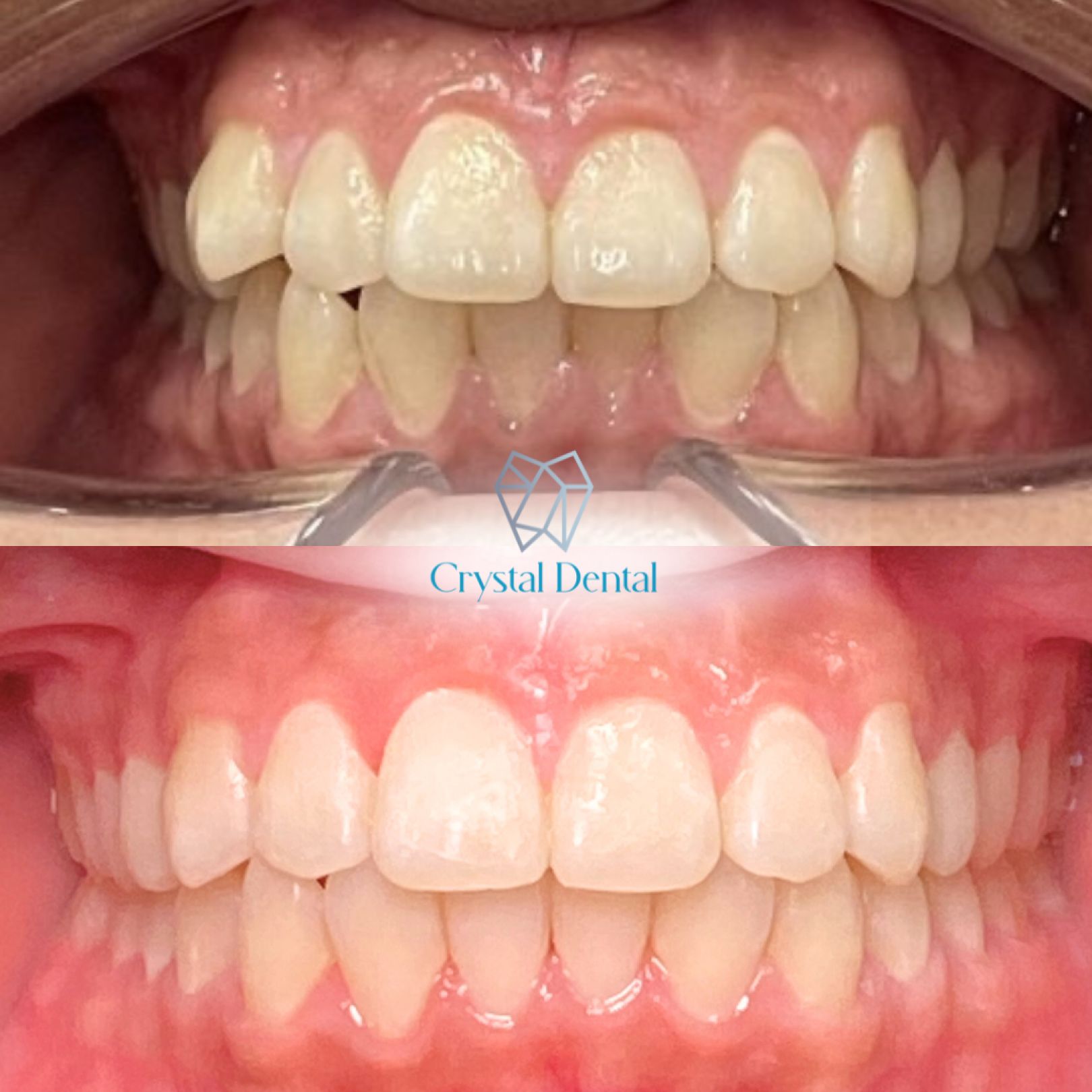 Invisalign Before After - 2